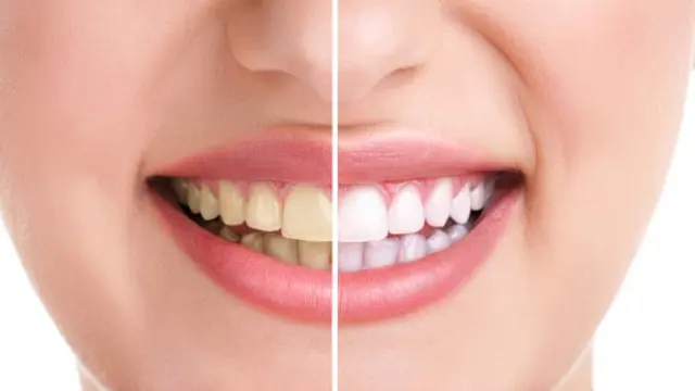 Bikin Tampil Percaya Diri, Berikut Tips Alami Memutihkan Gigi